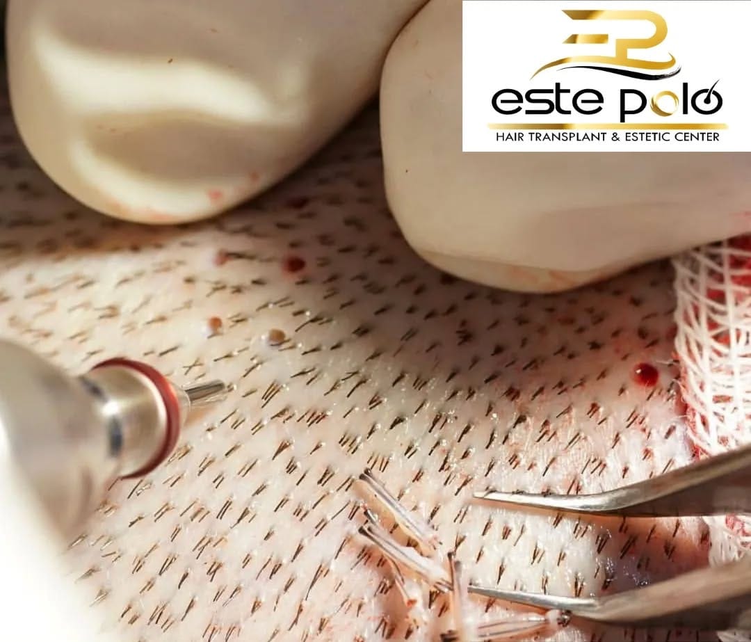 Post 8 by EstePolo Hair Transplant 👨🏻‍🦲🔁🧔🏻 on Instagram (image)