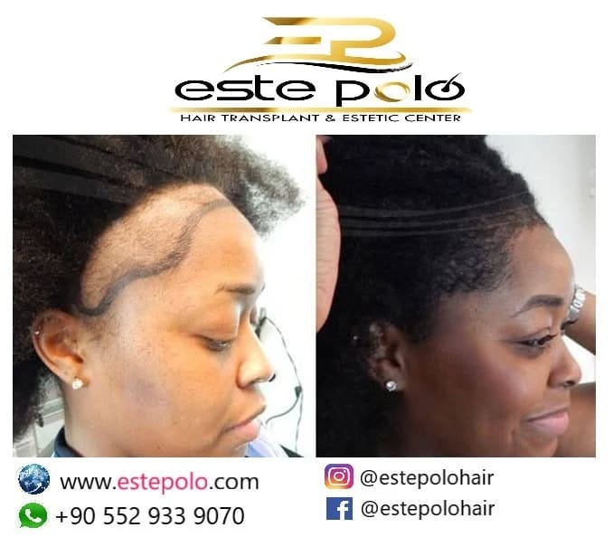 Post 3 by EstePolo Hair Transplant 👨🏻‍🦲🔁🧔🏻 on Instagram (image)
