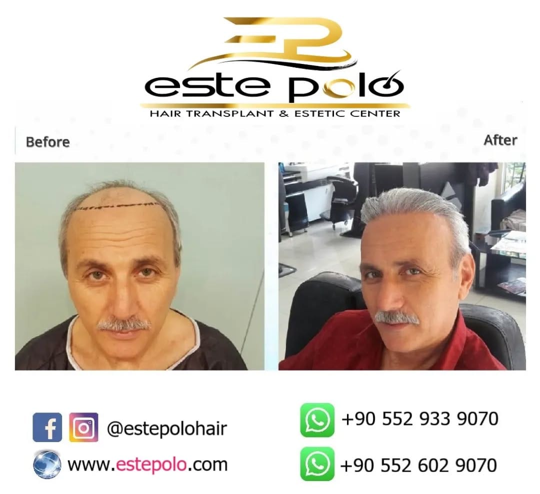 Post 9 by EstePolo Hair Transplant 👨🏻‍🦲🔁🧔🏻 on Instagram (image)