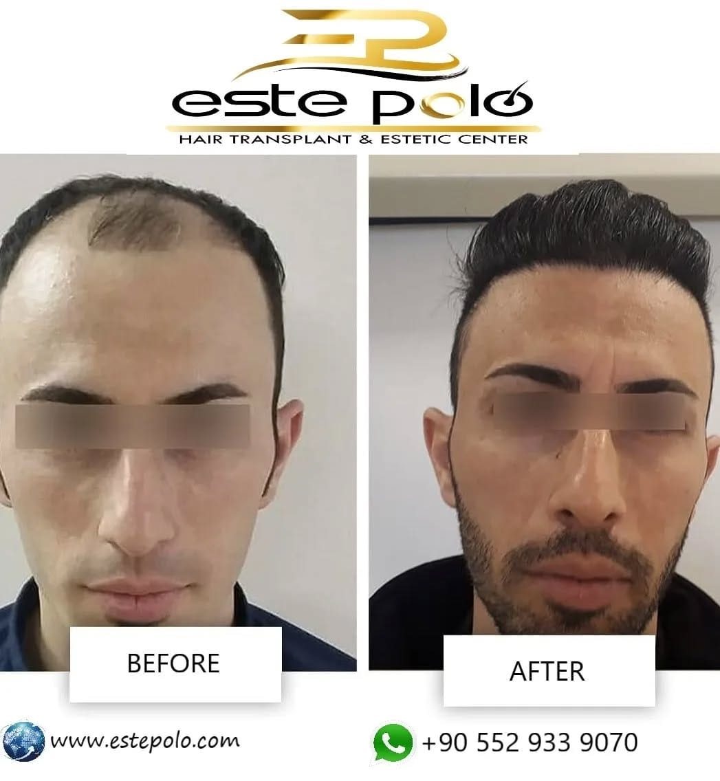 Post 5 by EstePolo Hair Transplant 👨🏻‍🦲🔁🧔🏻 on Instagram (image)