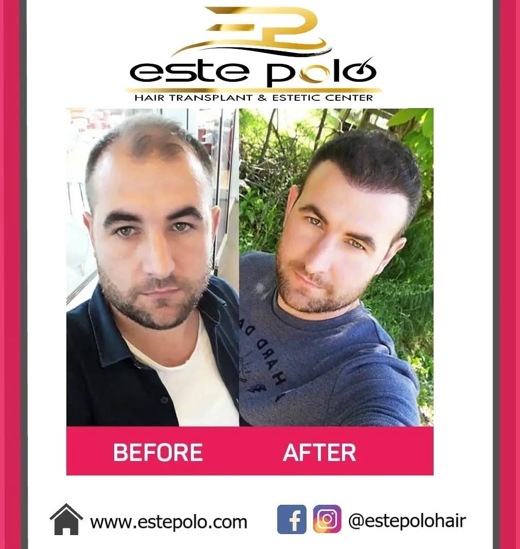 Post 4 by EstePolo Hair Transplant 👨🏻‍🦲🔁🧔🏻 on Instagram (image)