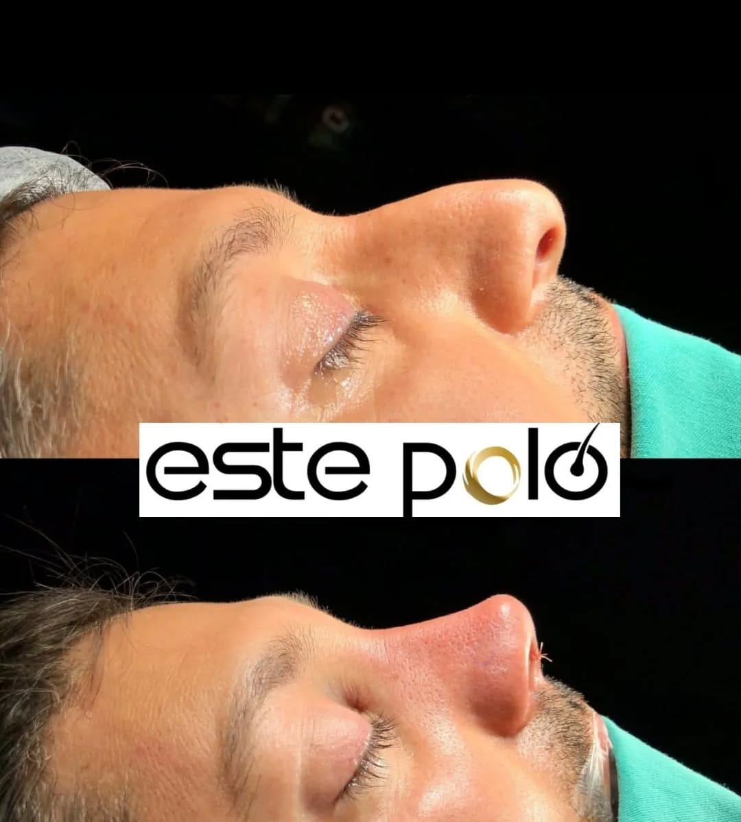 Post 7 by EstePolo Hair Transplant 👨🏻‍🦲🔁🧔🏻 on Instagram (image)