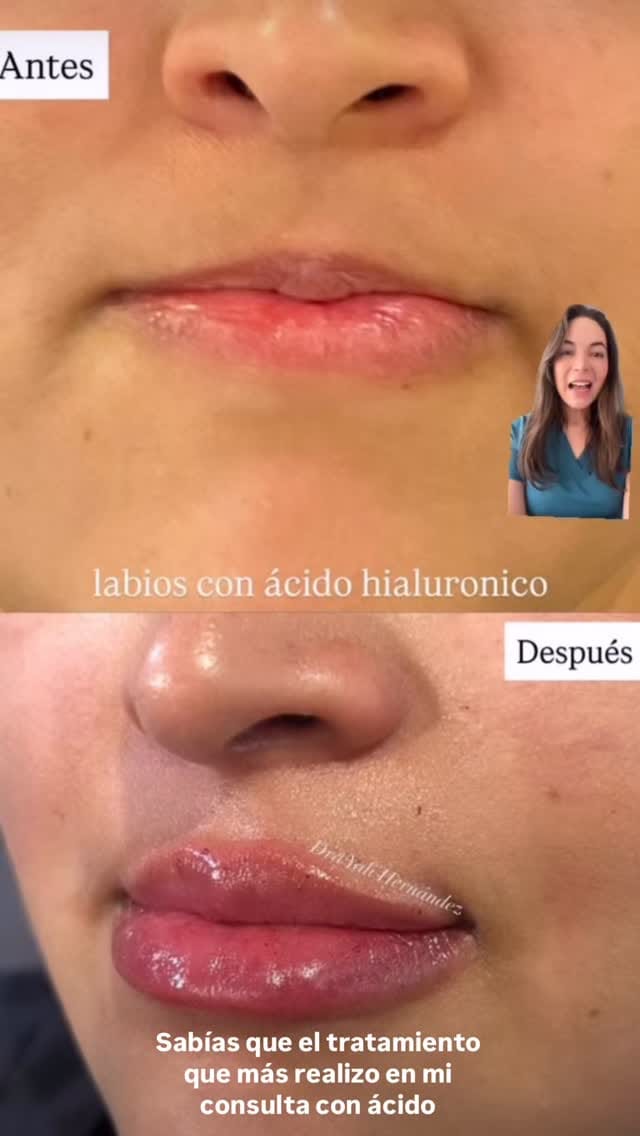 Post 3 by Dra Yali Hernandez MD Estética |Botox | acido Hialuronico on Instagram (video)
