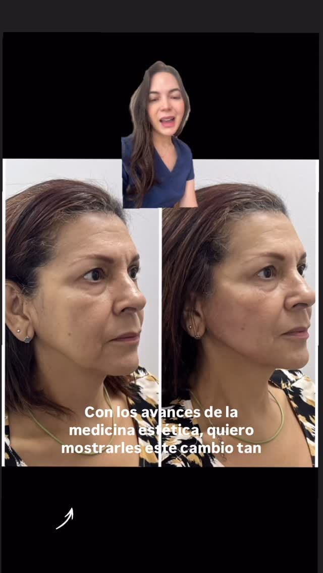 Post 1 by Dra Yali Hernandez MD Estética |Botox | acido Hialuronico on Instagram (video)