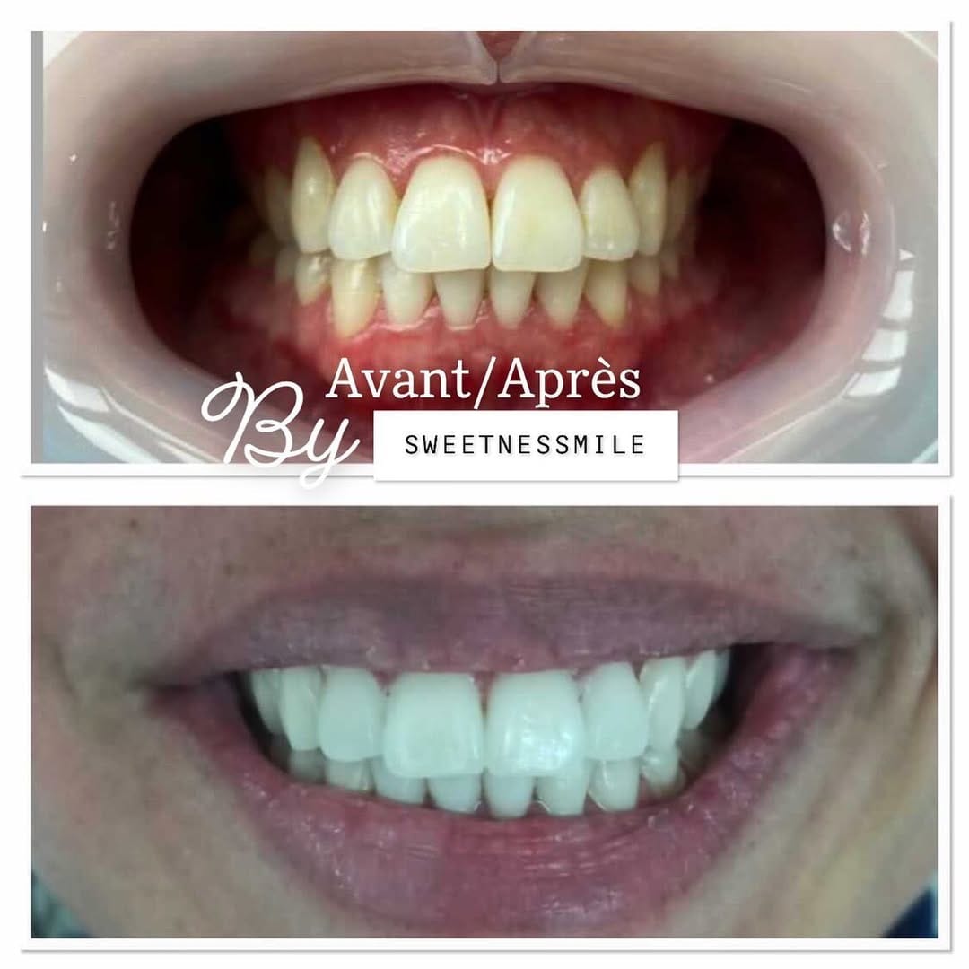 Post 3 by BLANCHIMENT DENTAIRE TOULOUSE on Instagram (image)