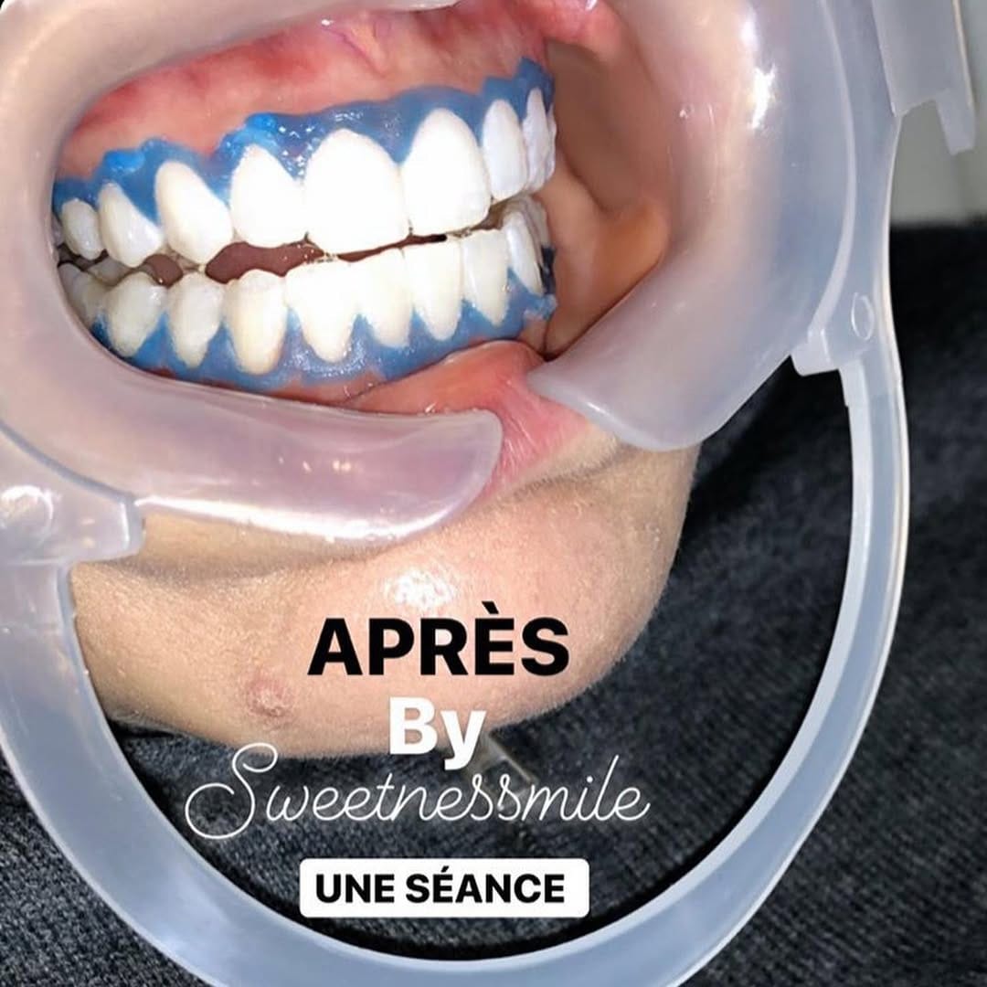 Post 6 by BLANCHIMENT DENTAIRE TOULOUSE on Instagram (carousel)