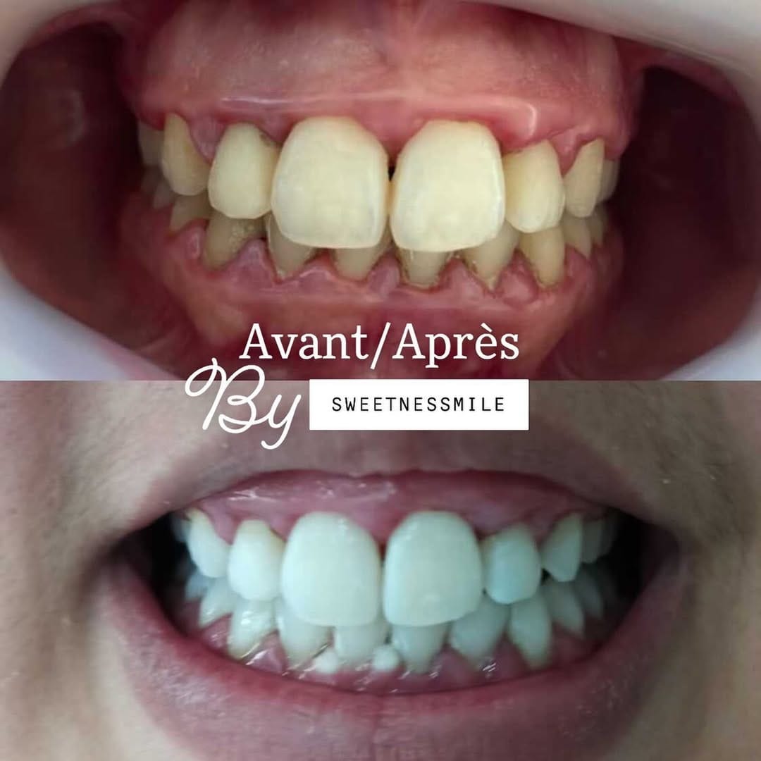 Post 5 by BLANCHIMENT DENTAIRE TOULOUSE on Instagram (image)