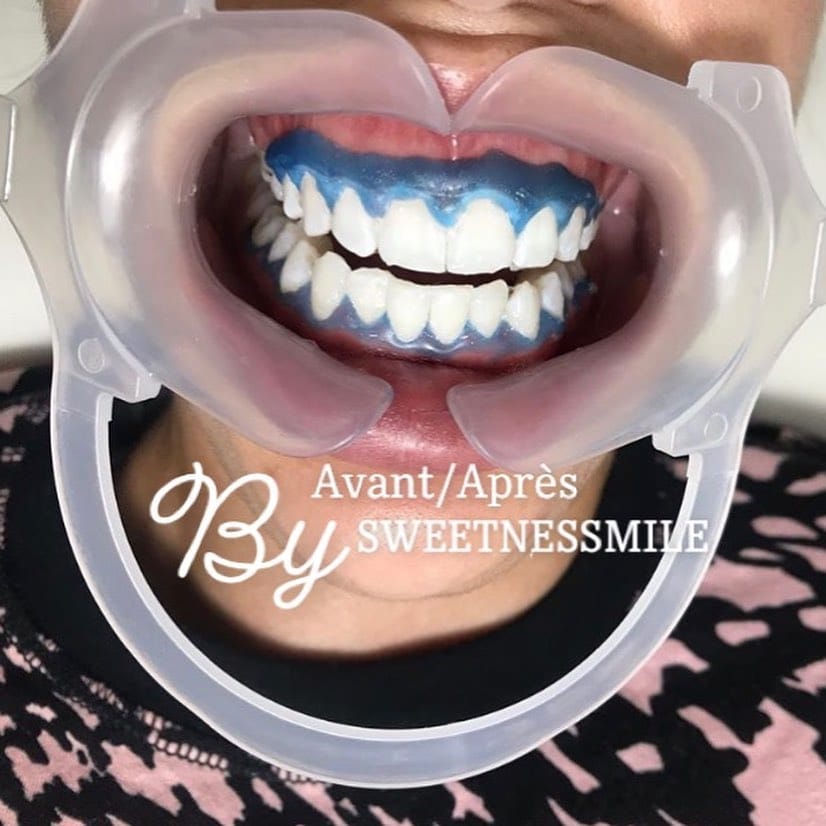 Post 7 by BLANCHIMENT DENTAIRE TOULOUSE on Instagram (carousel)
