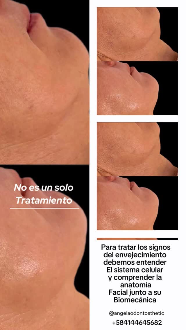 Post 1 by PhD. Angela Herrera | Odontología y Armonización Orofacial on Instagram (video)