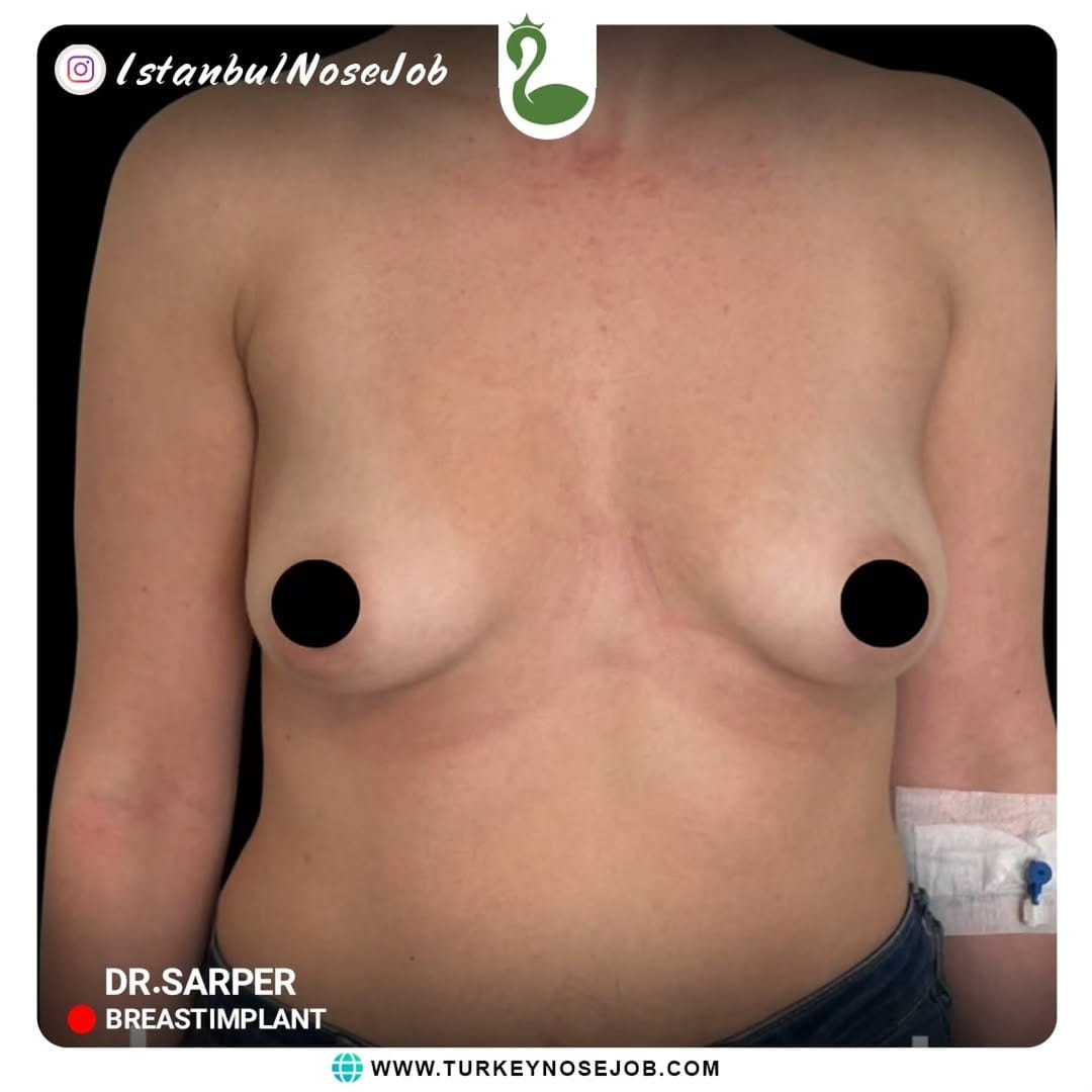 Post 3 by Plastic Surgery in Turkey🇹🇷 on Instagram (carousel)