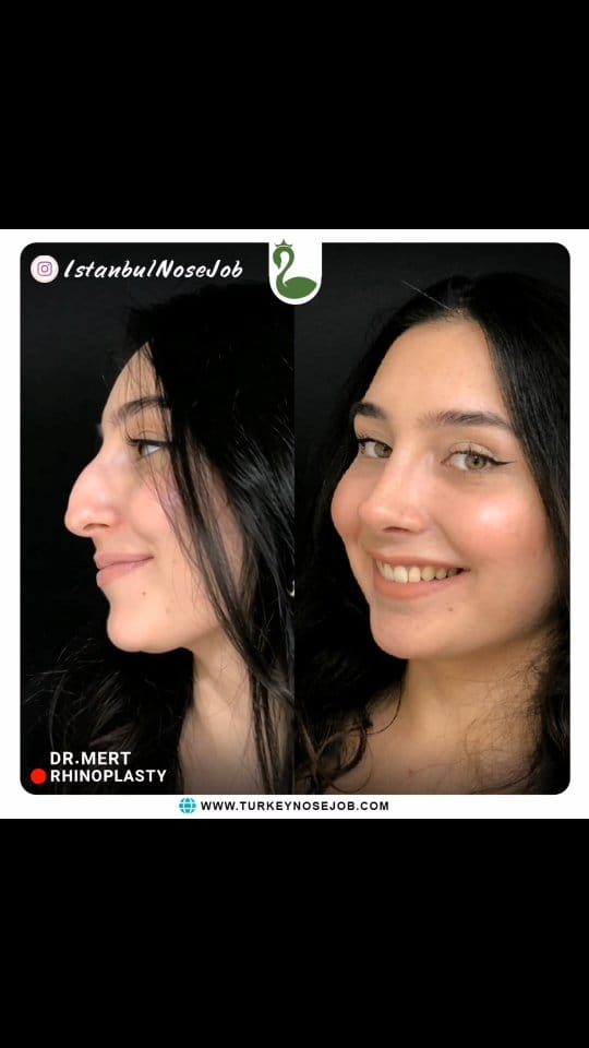 Post 10 by Plastic Surgery in Turkey🇹🇷 on Instagram (video)