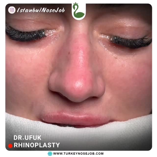 Post 2 by Plastic Surgery in Turkey🇹🇷 on Instagram (video)