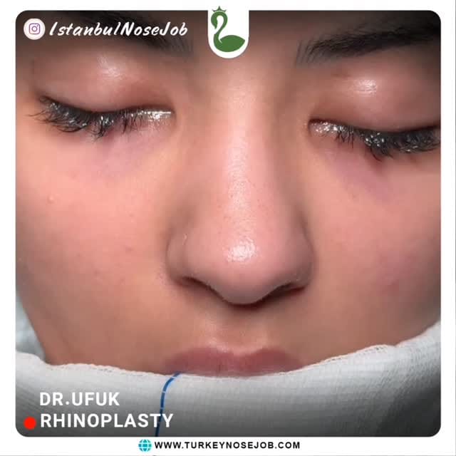 Post 6 by Plastic Surgery in Turkey🇹🇷 on Instagram (video)