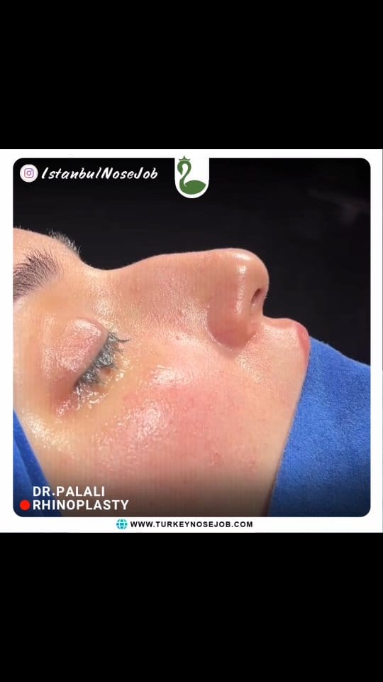 Post 5 by Plastic Surgery in Turkey🇹🇷 on Instagram (video)