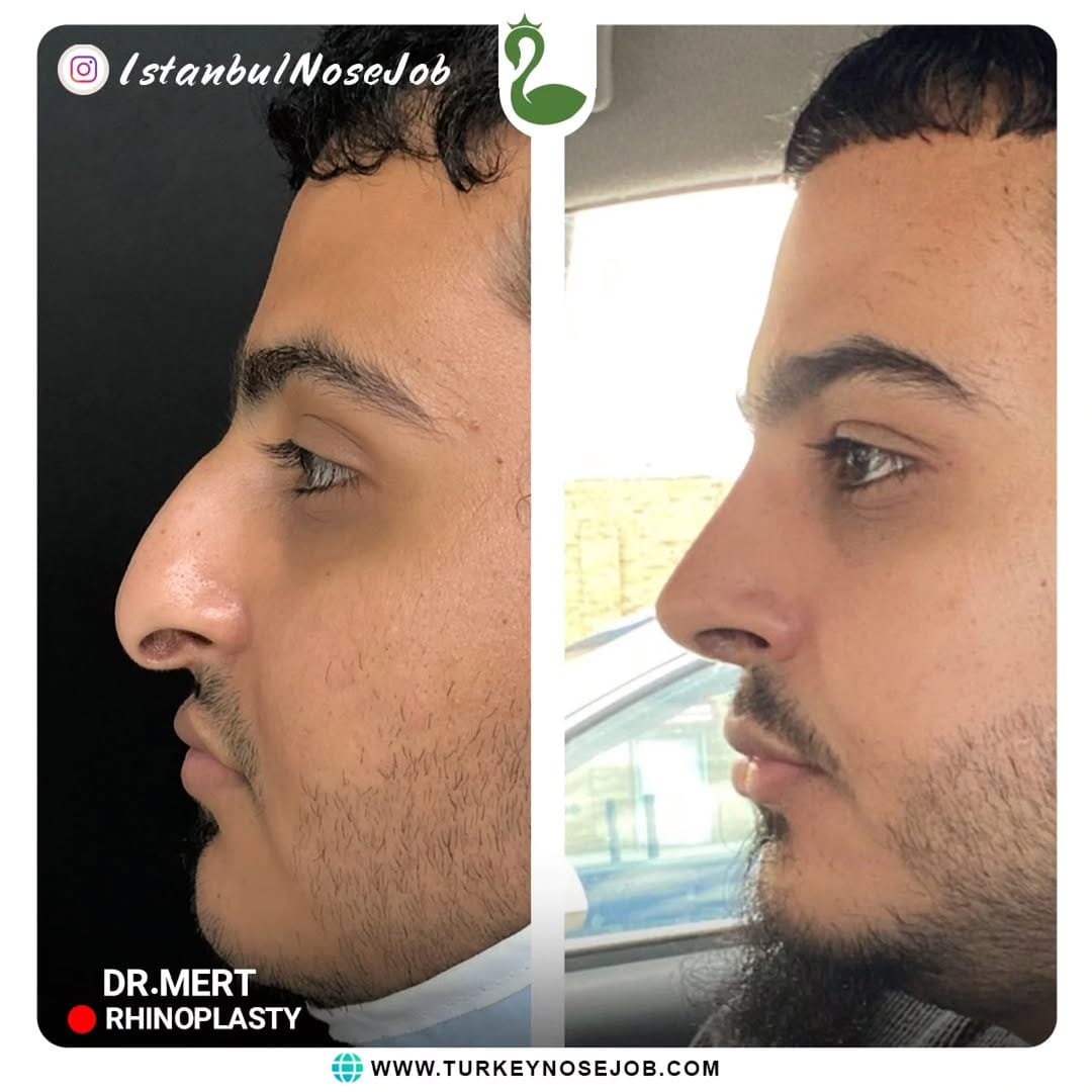 Post 4 by Plastic Surgery in Turkey🇹🇷 on Instagram (image)