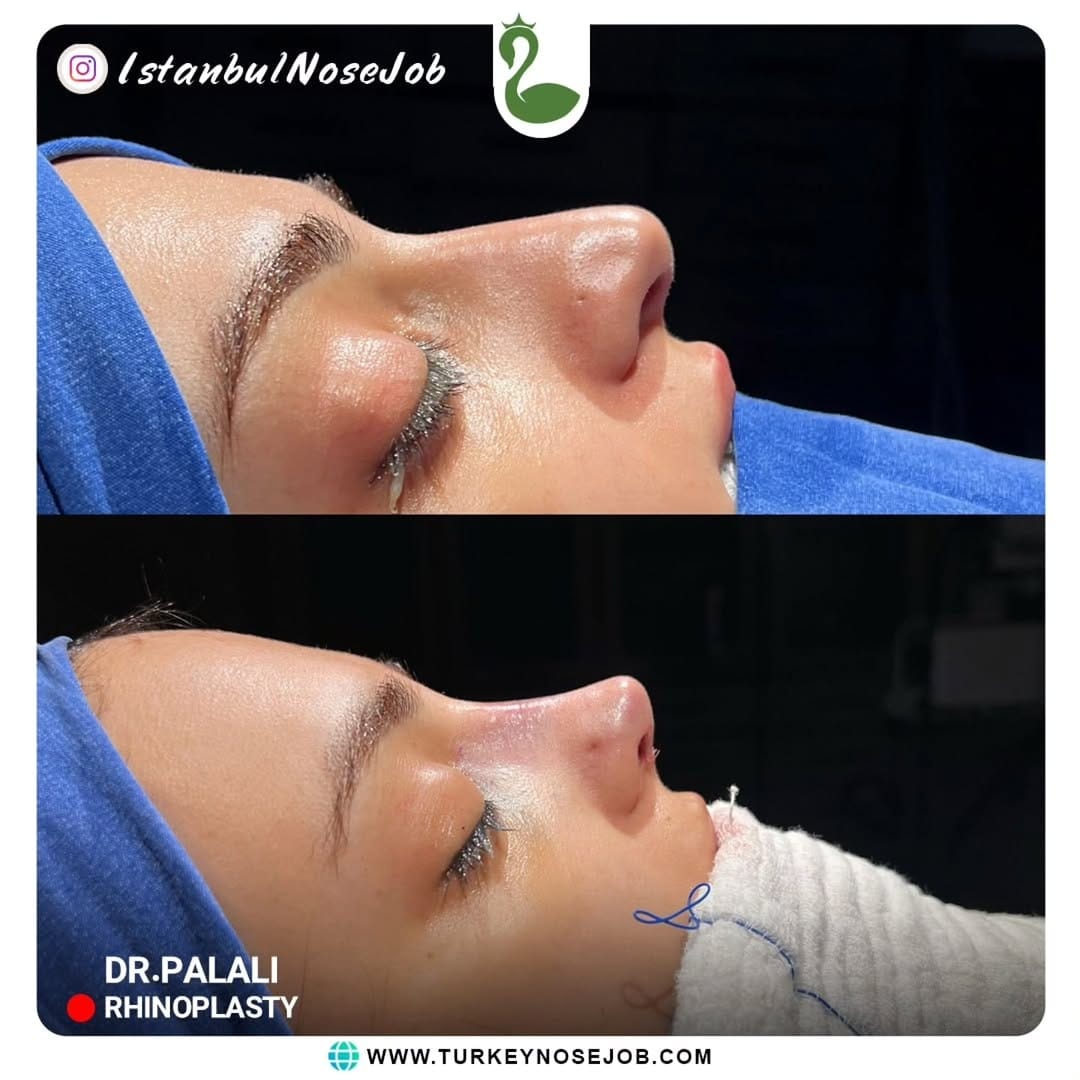 Post 9 by Plastic Surgery in Turkey🇹🇷 on Instagram (carousel)