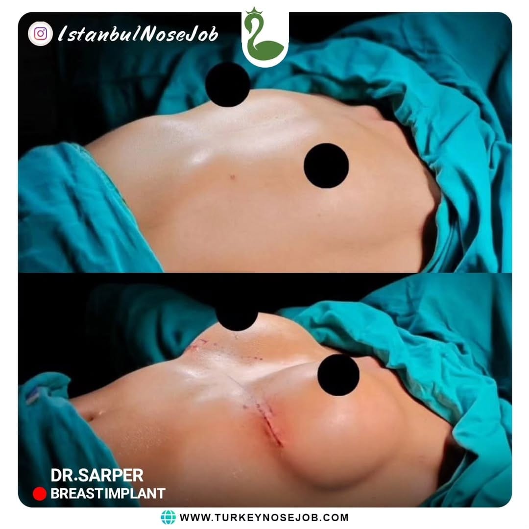 Post 8 by Plastic Surgery in Turkey🇹🇷 on Instagram (carousel)
