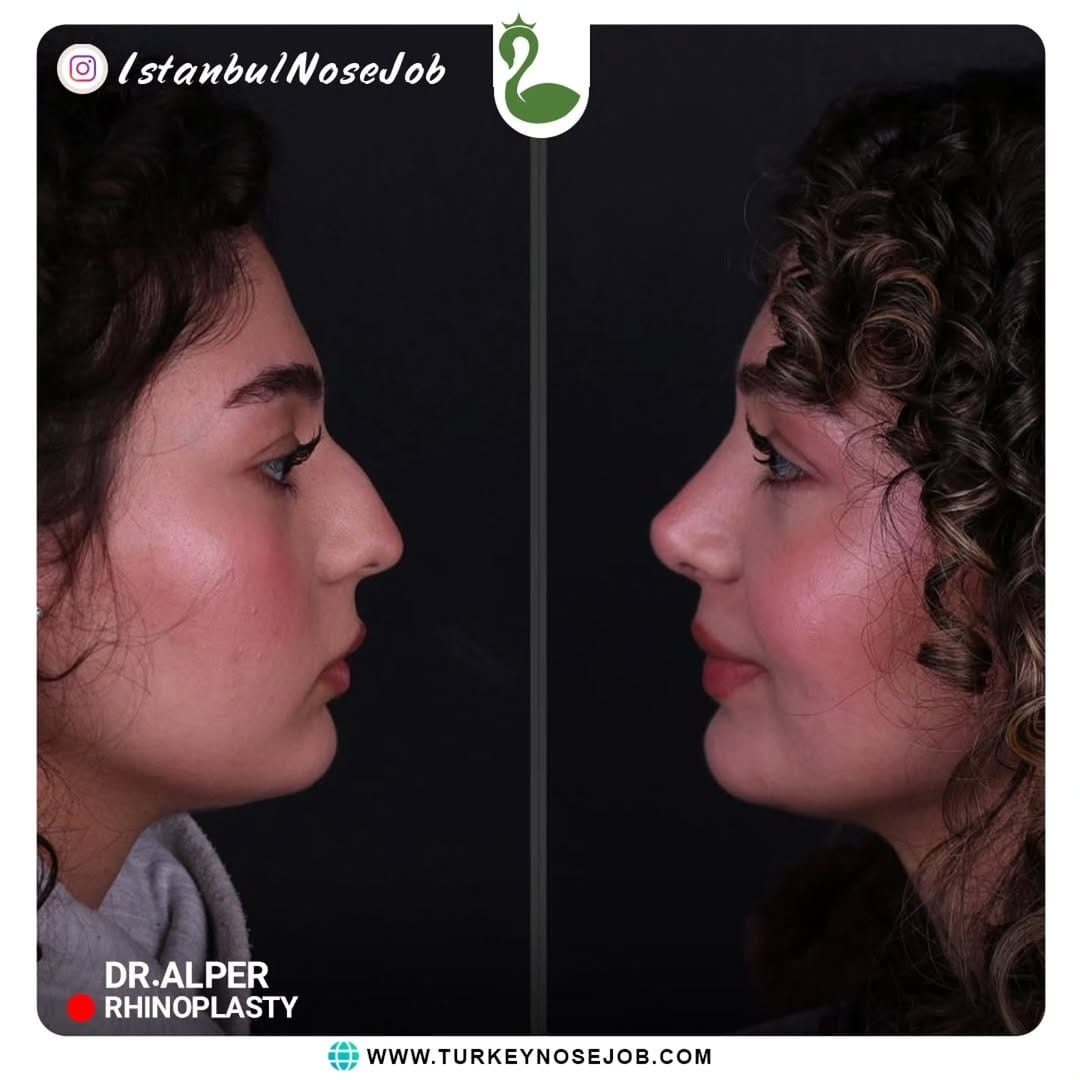 Post 1 by Plastic Surgery in Turkey🇹🇷 on Instagram (carousel)