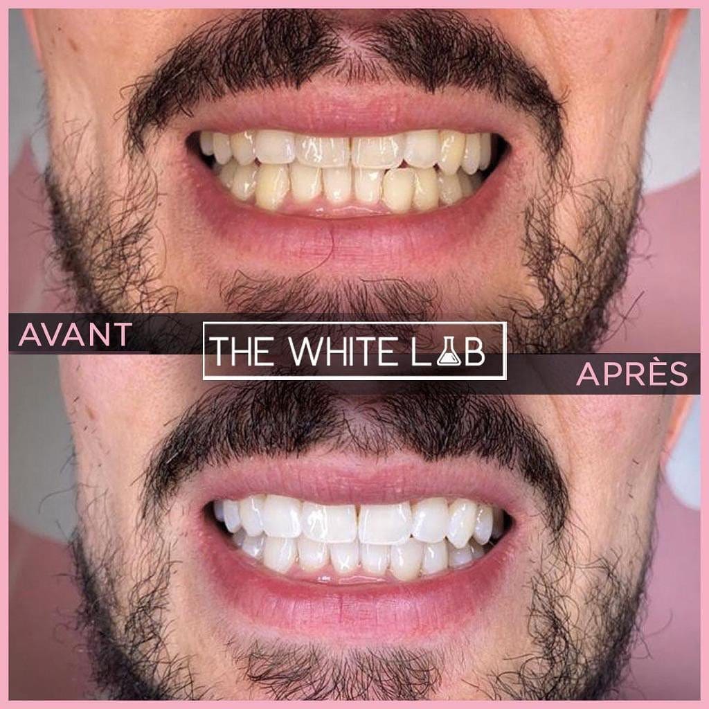 Post 10 by Blanchiment Dentaire Paris on Instagram (image)