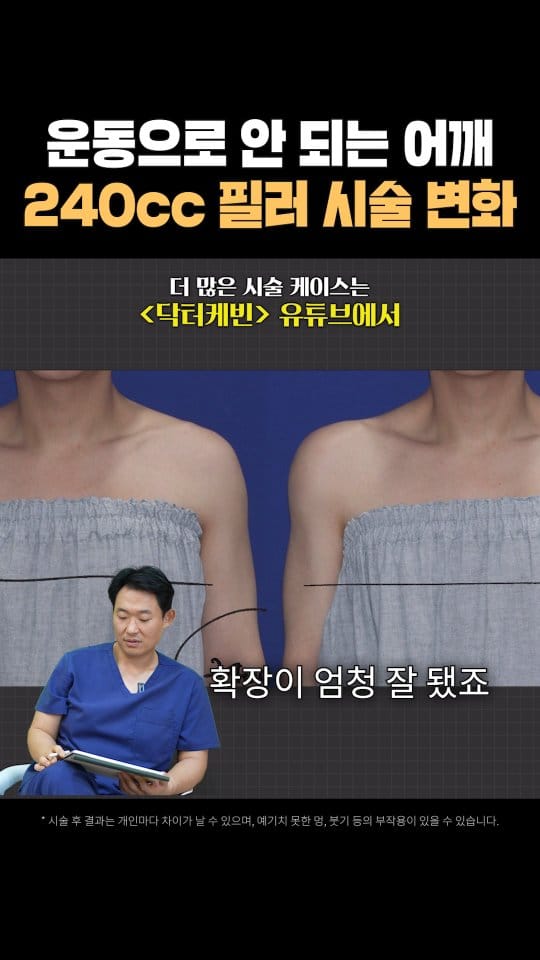 Post 7 by 닥터케빈의원 ㅣ키성형 어깨성형 두상성형ㅣ on Instagram (video)