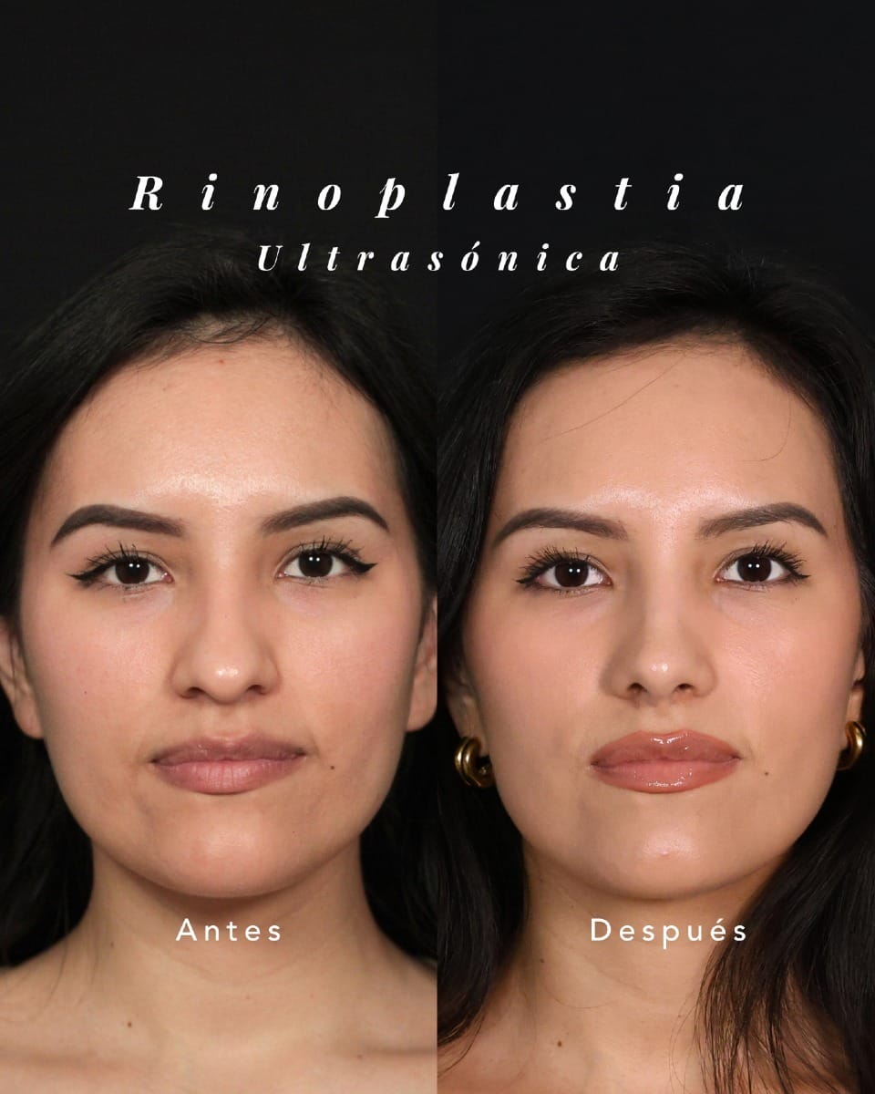 Post 10 by Maria T. Achiques | Rinoplastia on Instagram (carousel)