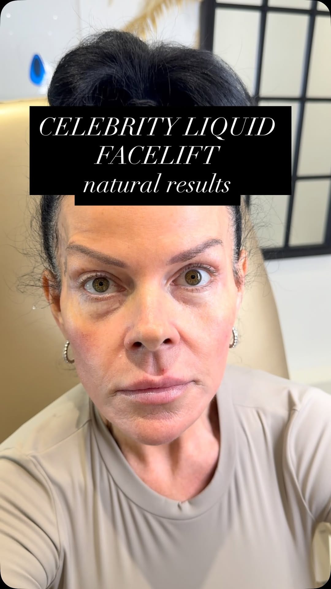 Post 10 by THE VOGUE CLINIC | AESTHETICS | LONDON • ESSEX •HERTS on Instagram (video)