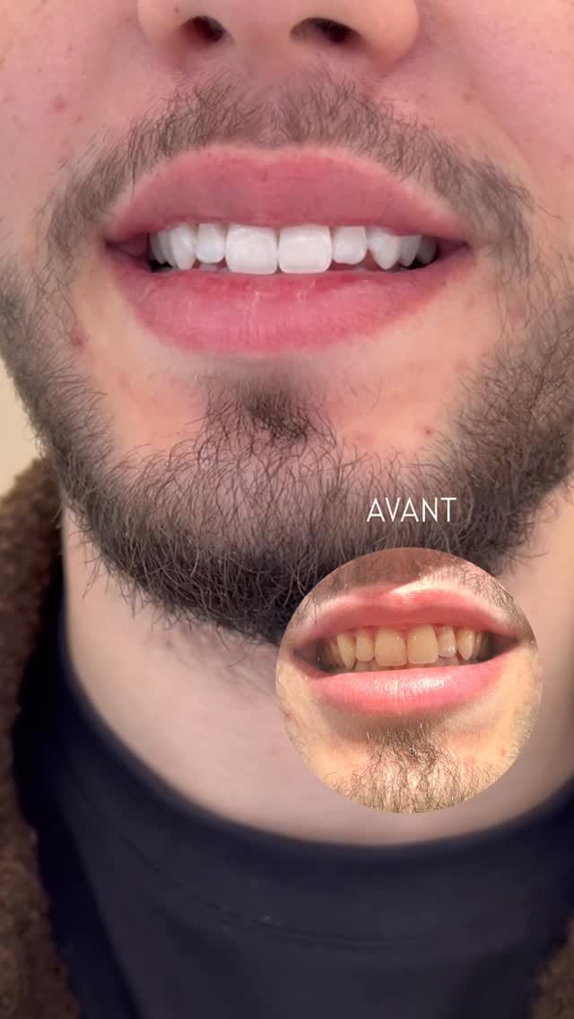 Post 6 by Blanchiment Dentaire Lyon on Instagram (video)