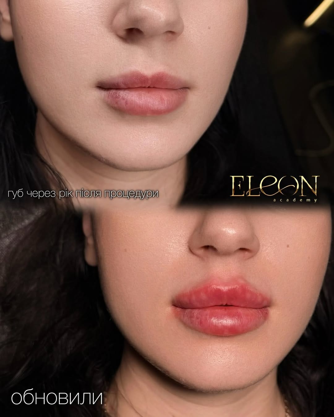 Post 6 by Косметолог💉ТОП🔝губи Тернопіль👄 on Instagram (carousel)