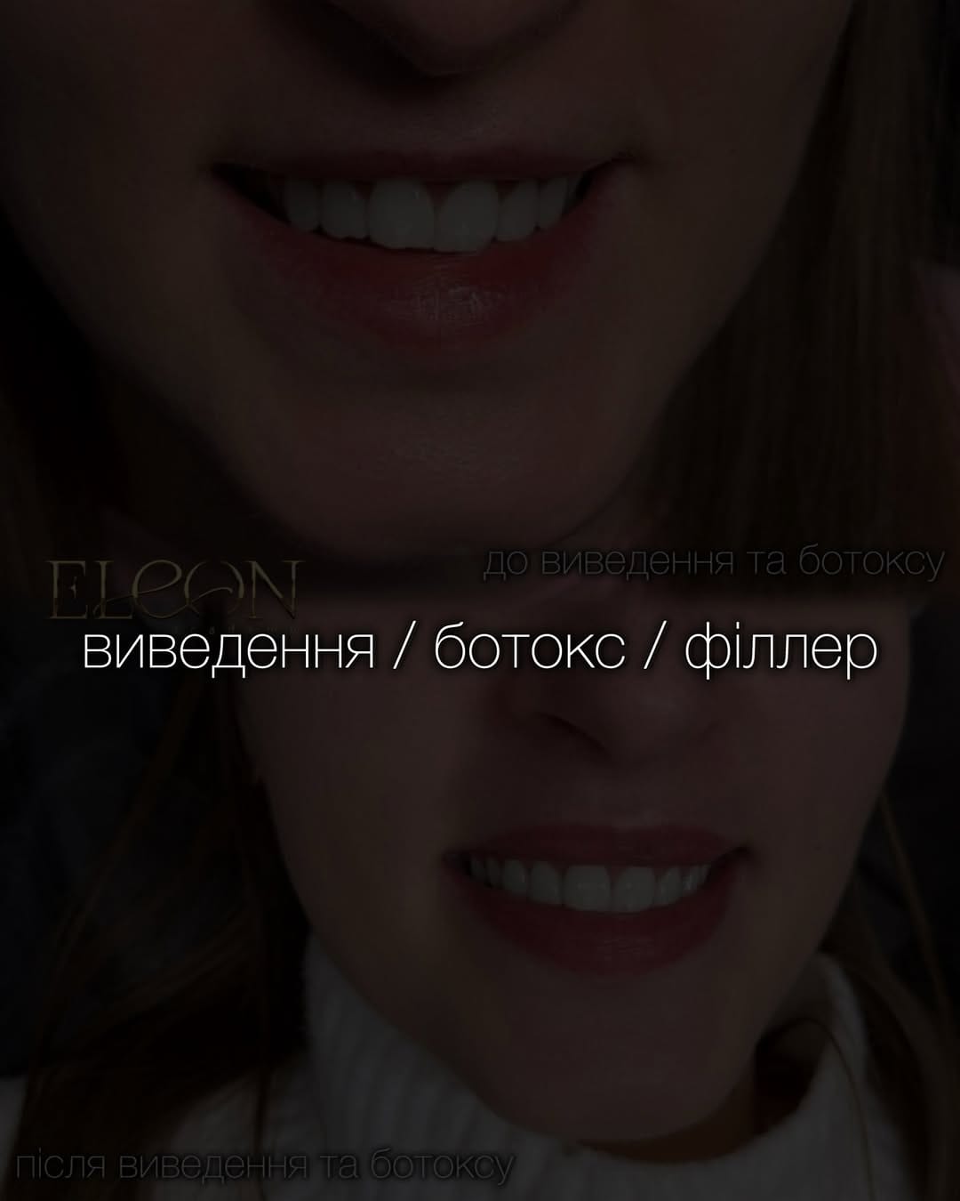 Post 2 by Косметолог💉ТОП🔝губи Тернопіль👄 on Instagram (carousel)