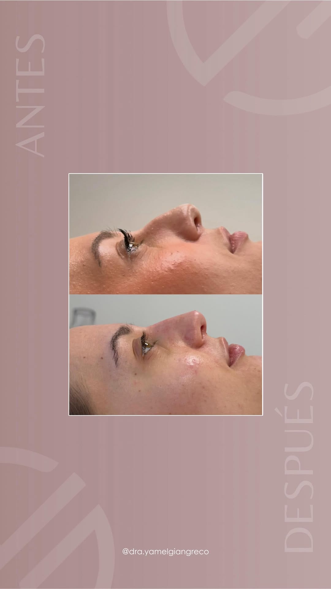 Post 1 by Dra. Yamel Giangreco | Medicina Estética on Instagram (video)