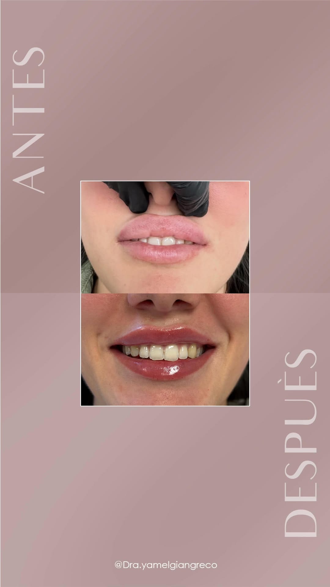 Post 7 by Dra. Yamel Giangreco | Medicina Estética on Instagram (video)
