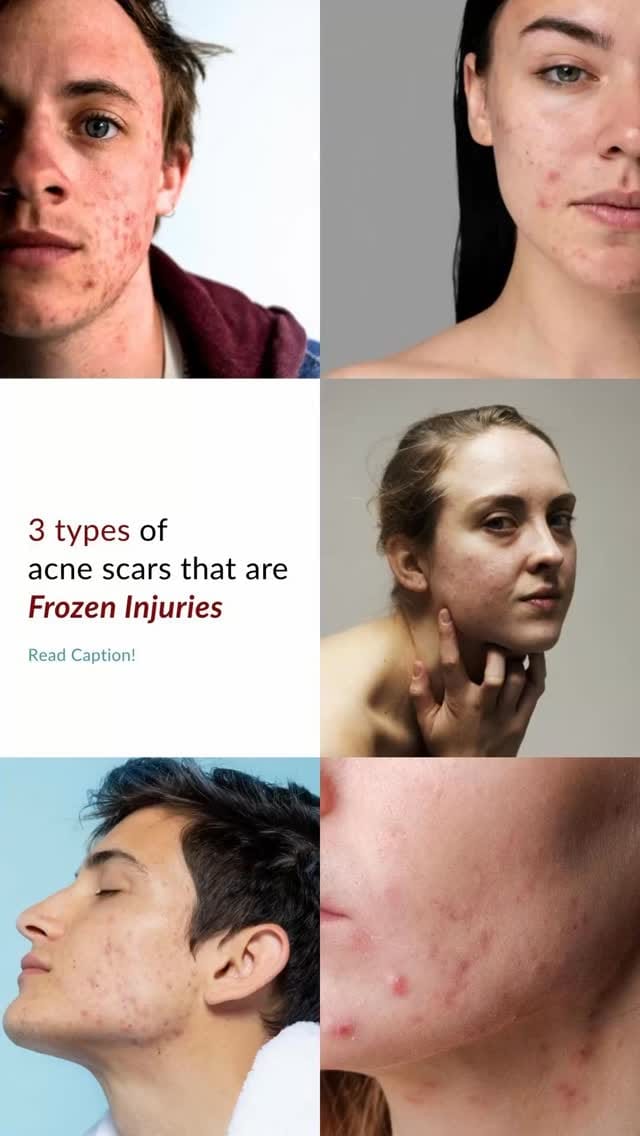 Post 2 by Tender Skin International | Skin & Hair Clinic on Instagram (video)