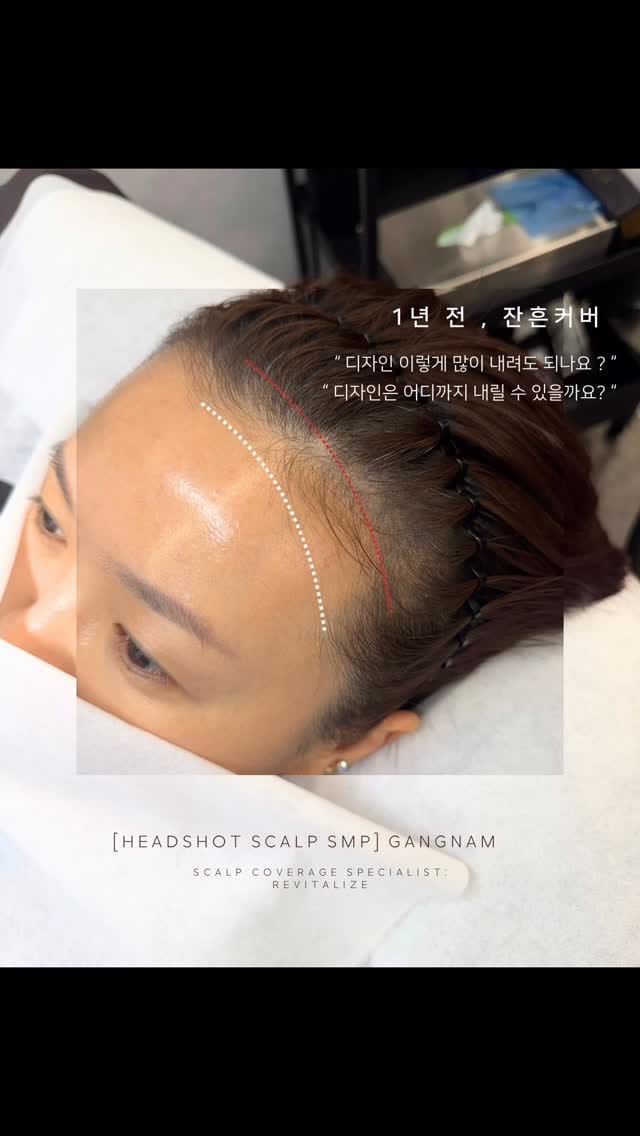 Post 4 by 두피문신 SMP수강 헤드샷스칼프본점 강남두피문신 분당두피문신 on Instagram (video)