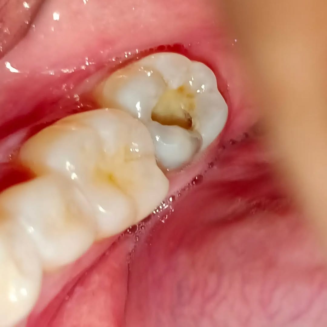 Post 3 by Tooth doctor 😁🦷 on Instagram (carousel)