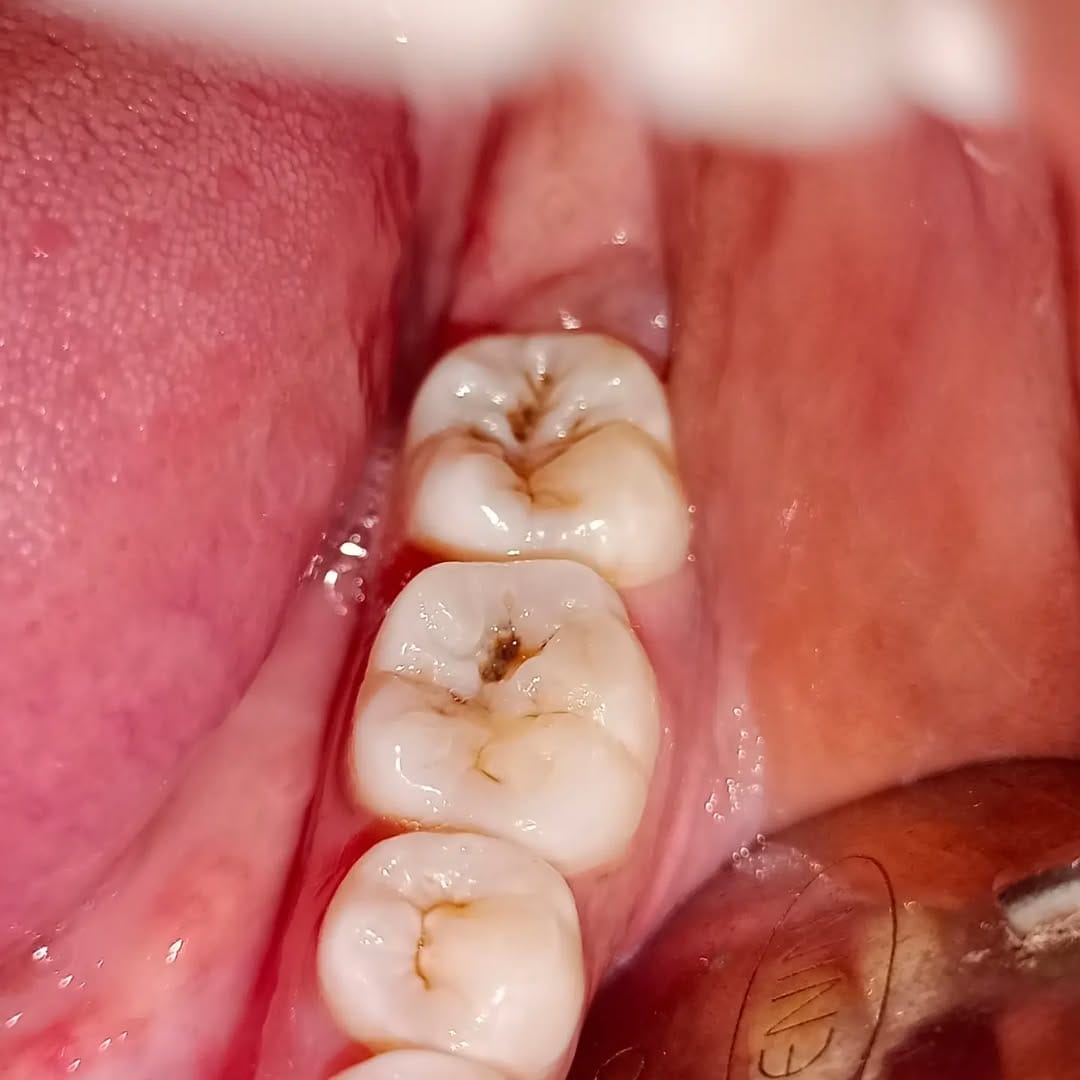 Post 5 by Tooth doctor 😁🦷 on Instagram (carousel)