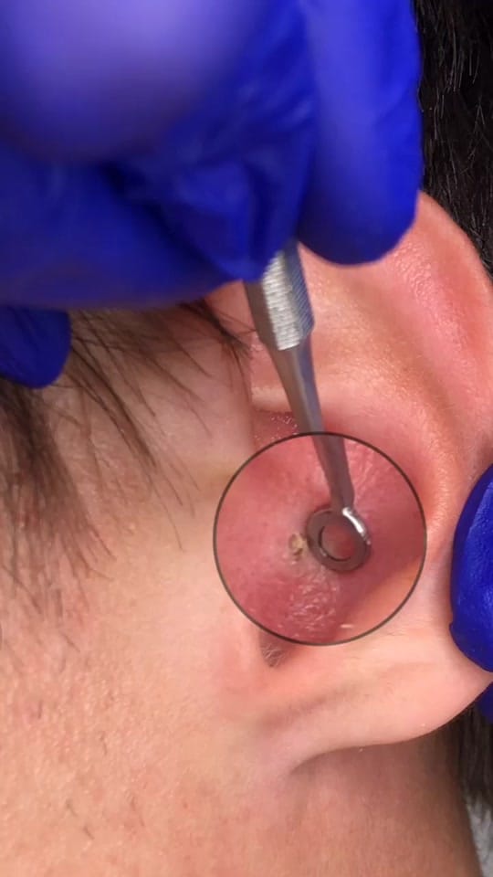 Post 9 by Skin Plus Acne Clinic ATX on TikTok (video)
