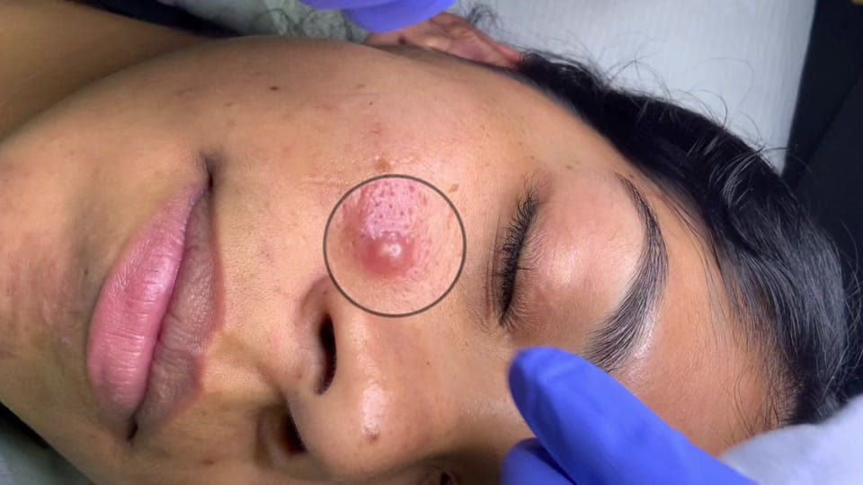 Post 8 by Skin Plus Acne Clinic ATX on TikTok (video)