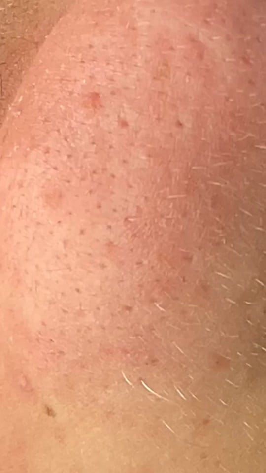Post 10 by Skin Plus Acne Clinic ATX on TikTok (video)