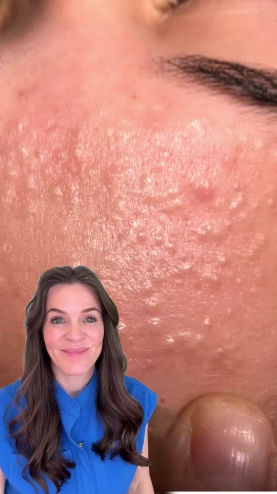 Post 2 by Skin Plus Acne Clinic ATX on TikTok (video)