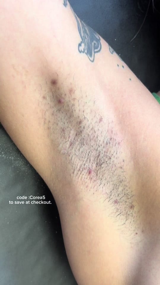 Post 8 by COREA🩷 | DALLAS ESTHETICIAN on TikTok (video)