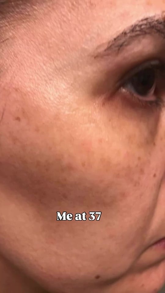 Post 3 by Sarit | Melasma Expert on TikTok (video)