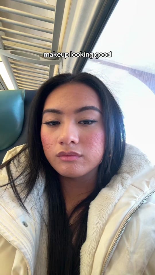 Post 9 by jennilee • thatacnegirlie on TikTok (video)