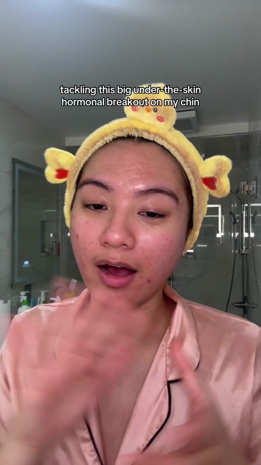 Post 3 by jennilee • thatacnegirlie on TikTok (video)