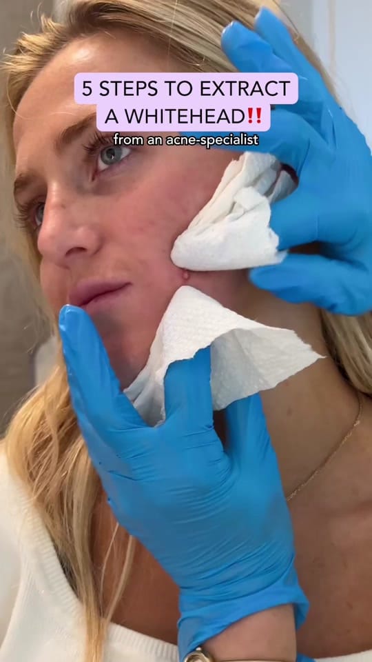 Post 4 by The Acne Guru on TikTok (video)