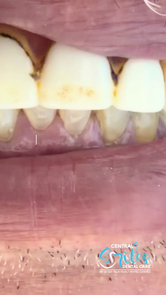 Post 4 by centralsmilesdentalcare on TikTok (video)