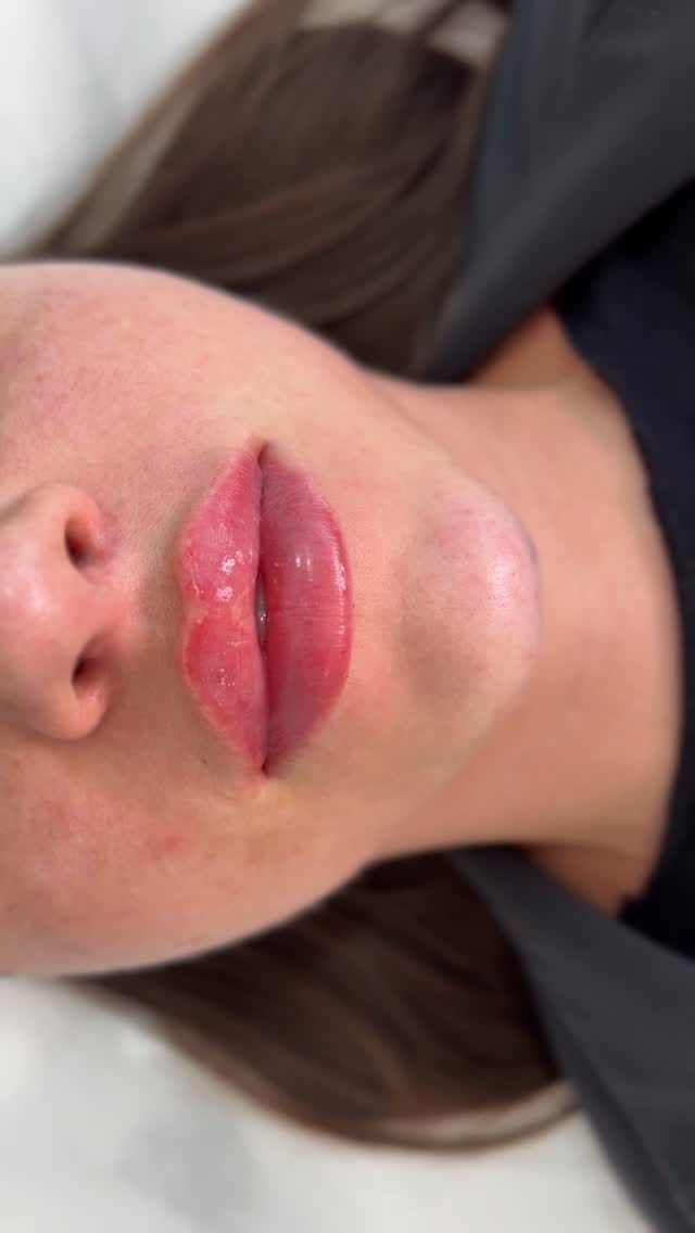 Post 8 by Lips • Botox | Brooklyn • New York • Miami on Instagram (video)