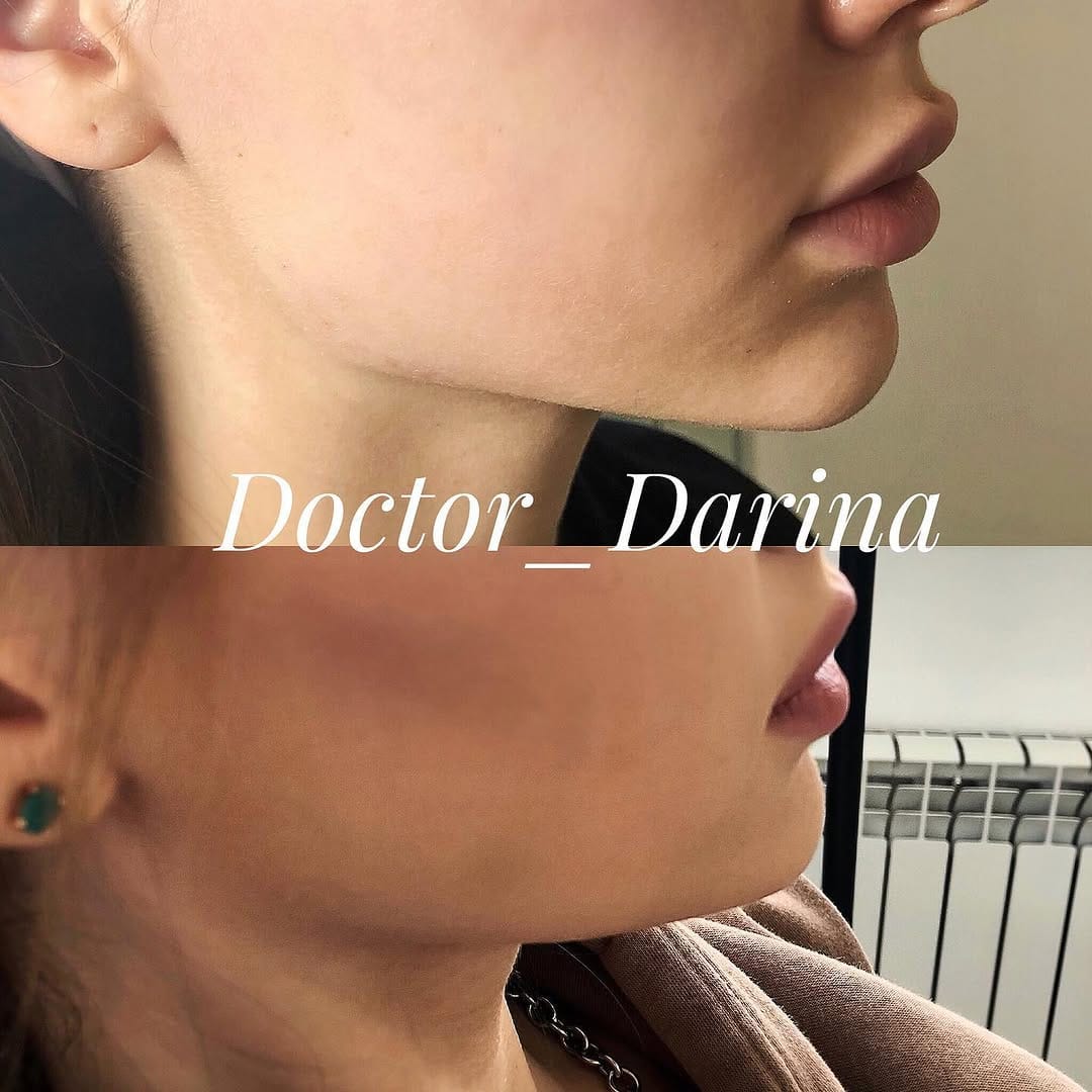 Post 10 by Lips • Botox | Brooklyn • New York • Miami on Instagram (image)
