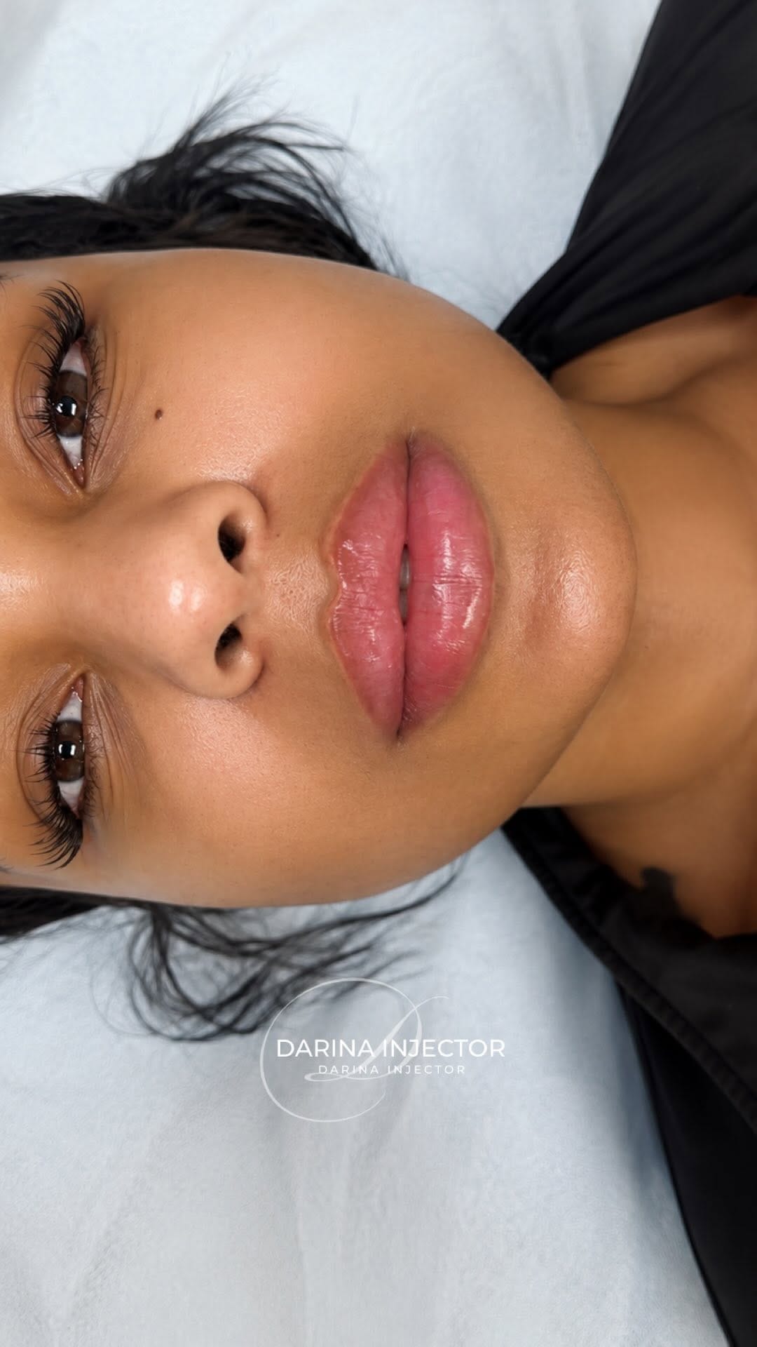 Post 2 by Lips • Botox | Brooklyn • New York • Miami on Instagram (video)