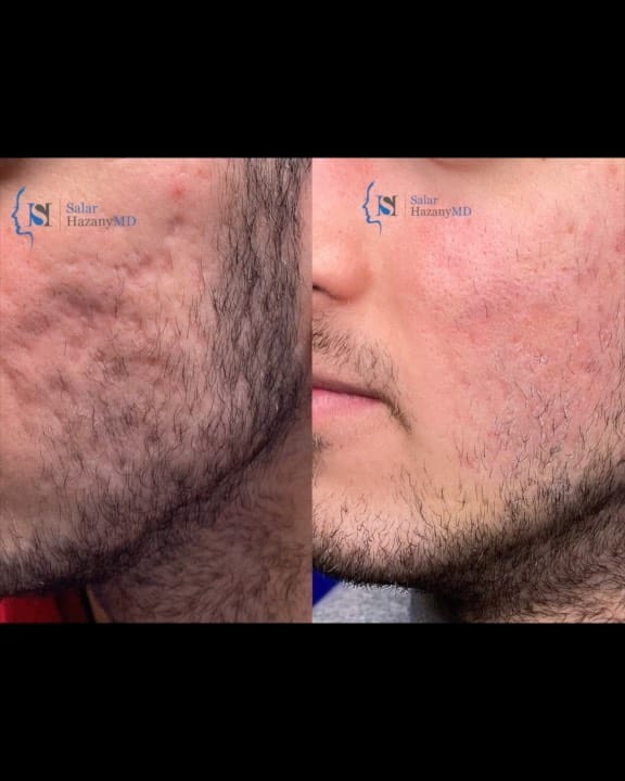 Post 10 by Salar Hazany MD, FAAD, FACMS on Instagram (video)