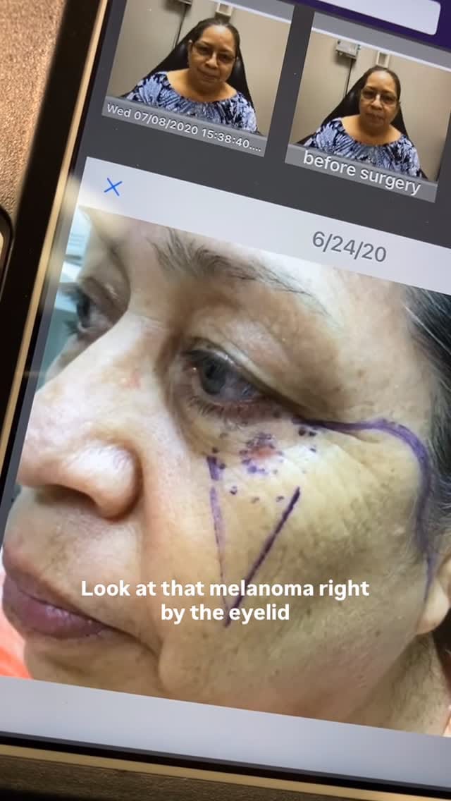 Post 1 by Salar Hazany MD, FAAD, FACMS on Instagram (video)
